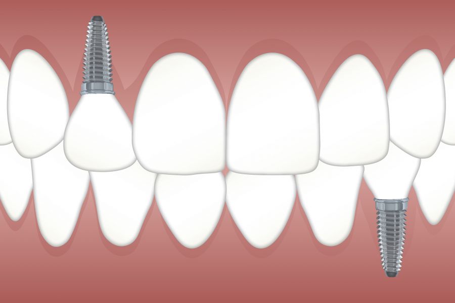Implants vs Crowns vs Bridges