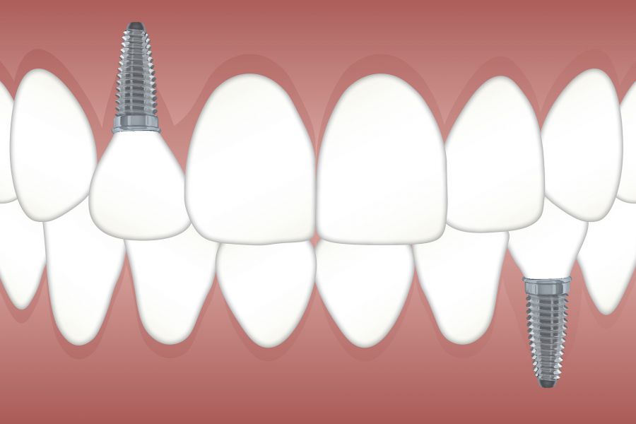 Implants vs Crowns vs Bridges 