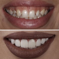 Dentistry Turkey Gum Aesthetic Before After 2