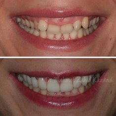 Dentistry Turkey Gum Aesthetic Before After 3