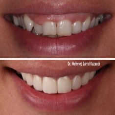 Dentistry Turkey Gum Aesthetic Before After 1