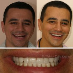 Dentistry Turkey Before After 3