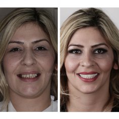 Dentistry Turkey Before After 6
