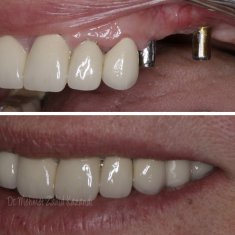 Dental Implants Turkey Before After 11