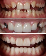 Dental Implants Turkey Before After 10