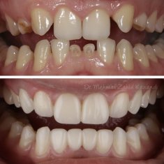 Dental Implants Turkey Before After 9