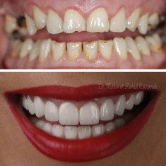 Dental Implants Turkey Before After 8