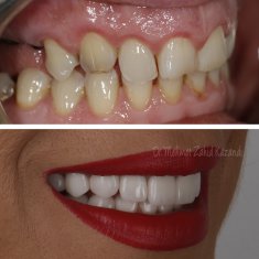 Dental Implants Turkey Before After 7