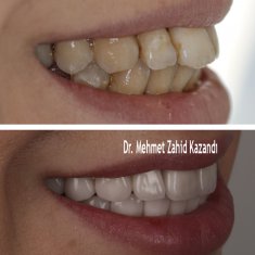 Dental Implants Turkey Before After 6