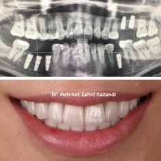 Dental Implants Turkey Before After 5