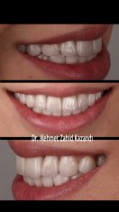 Dental Implants Turkey Before After 4