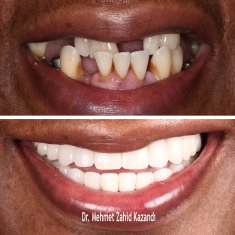 Dental Implants Turkey Before After 3