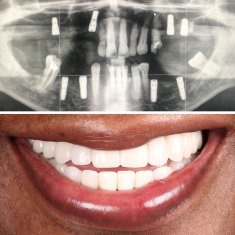 Dental Implants Turkey Before After 2