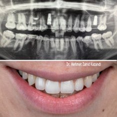 Dental Implants Turkey Before After 1
