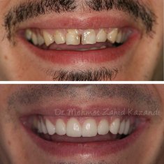 Veneers Turkey Before After 16