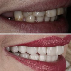 Veneers Turkey Before After 2