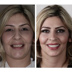 Veneers Turkey Before After 1