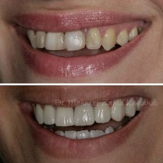 Veneers Turkey Before After 14