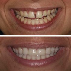 Veneers Turkey Before After 12