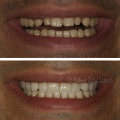 Veneers Turkey Before After 10