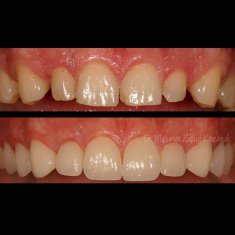 Veneers Turkey Before After 8