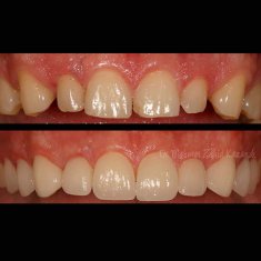 Veneers Turkey Before After 8