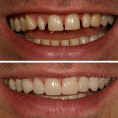 Veneers Turkey Before After 18