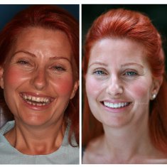 Veneers Turkey Before After 5