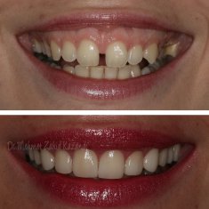 Veneers Turkey Before After 4