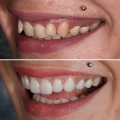 Veneers Turkey Before After 50