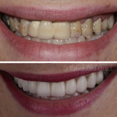 Veneers Turkey Before After 49