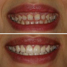 Veneers Turkey Before After 54