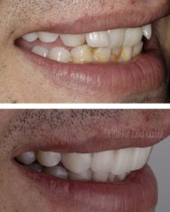 Veneers Turkey Before After 48