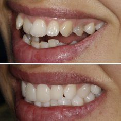 Veneers Turkey Before After 47