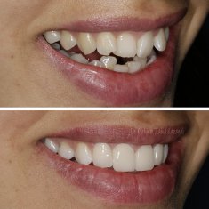 Veneers Turkey Before After 46