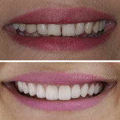 Veneers Turkey Before After 45