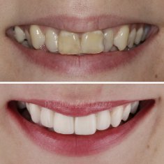 Veneers Turkey Before After 44