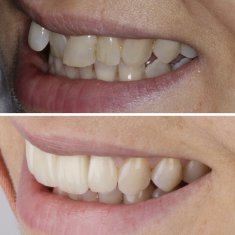 Veneers Turkey Before After 43