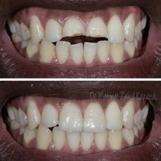 Veneers Turkey Before After 42