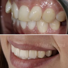 Veneers Turkey Before After 41