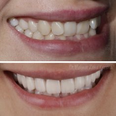 Veneers Turkey Before After 40