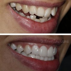 Veneers Turkey Before After 38