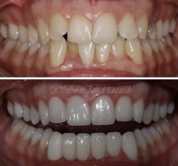 Veneers Turkey Before After 39