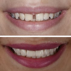 Veneers Turkey Before After 37