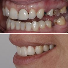 Veneers Turkey Before After 36