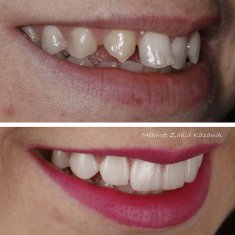 Veneers Turkey Before After 35