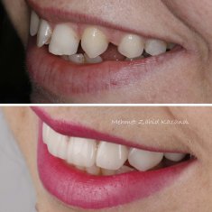 Veneers Turkey Before After 34