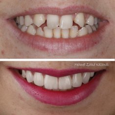 Veneers Turkey Before After 33