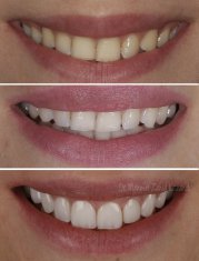 Veneers Turkey Before After 32