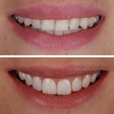 Veneers Turkey Before After 31